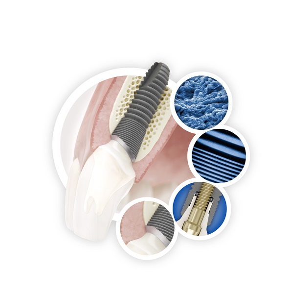 Dış Implantları