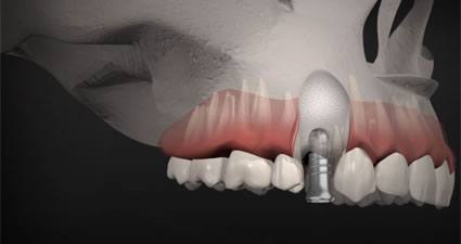 DİŞ IMPLANTLARI