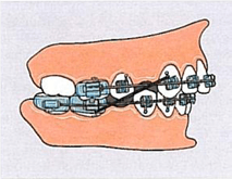 Üst Çene Dentoalveolar Pozisyon