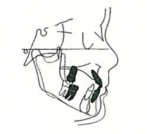 Üst Çene Dentoalveolar Pozisyon 3