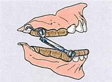 Üst Çene Dentoalveolar Pozisyon 6