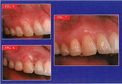 Üst Çene Dentoalveolar Pozisyon 8
