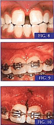 Üst Çene Dentoalveolar Pozisyon 9