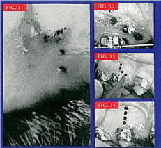Üst Çene Dentoalveolar Pozisyon 10