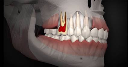 PERİODONTAL HASTALIK